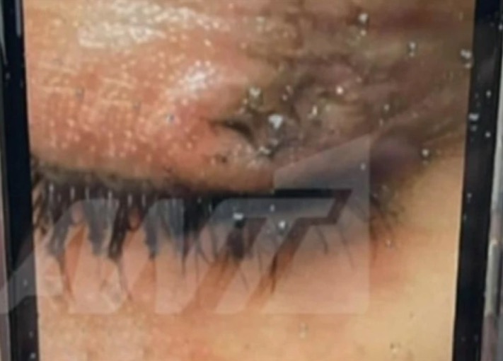 Δραπετσώνα: Συνελήφθη η 16χρονη που έσβησε τσιγάρο στο μάτι συμμαθήτριάς της στο σχολείο