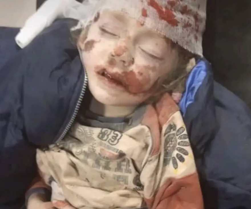 Ουκρανία: Η συγκλονιστική φωτογραφία τραυματισμένου παιδιού από τους βομβαρδισμούς των Ρώσων